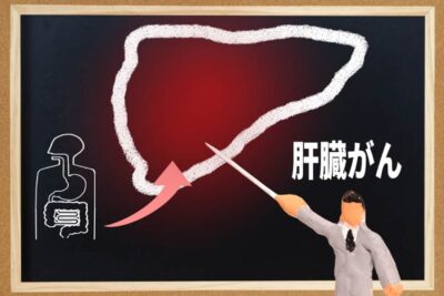【肝臓病専門医が解説】肝臓がんと言われたら? 主な6つの治療法と選び方のアイキャッチ画像