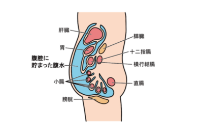 Severe Ascites Due to Liver Cirrhosis: Before Giving Up Thinking It Is Too Late, Consider Stem Cell Therapy as an Optionのアイキャッチ画像