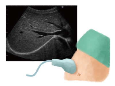 Is That Abdominal Swelling “Ascites”? Causes and Treatments for Fluid Accumulation in Liver Cirrhosisのアイキャッチ画像